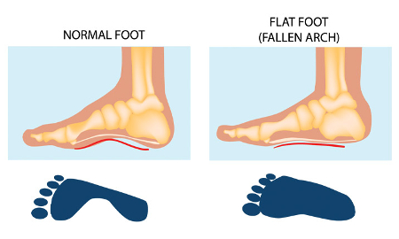 flat feet causes