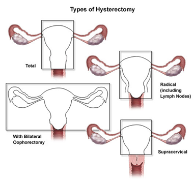 types of hysterectomy